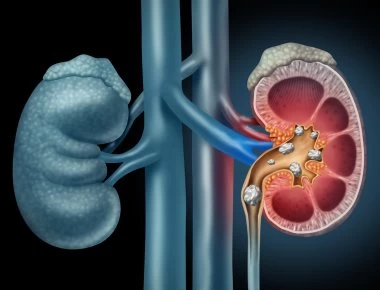 Πώς θα καταλάβετε αν έχετε πέτρες στα νεφρά (βίντεο)